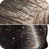 Flaky scalp close-up