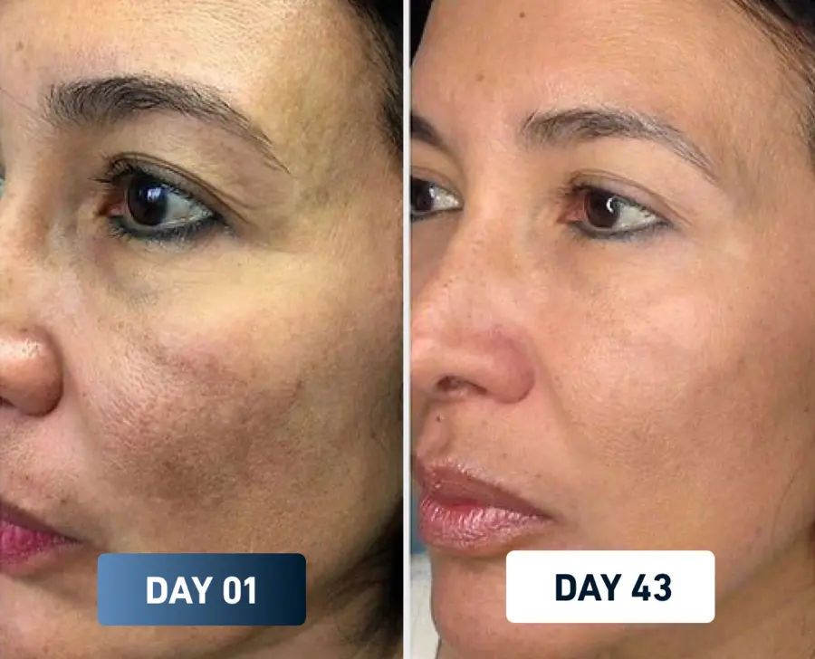 Skin before and after