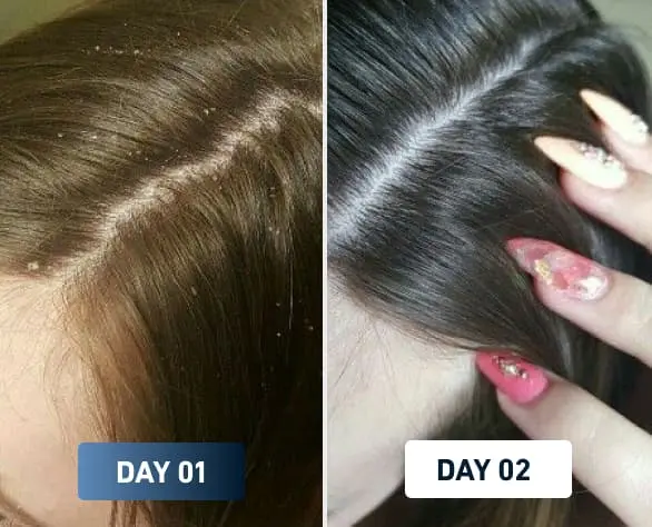 Scalp before and after
